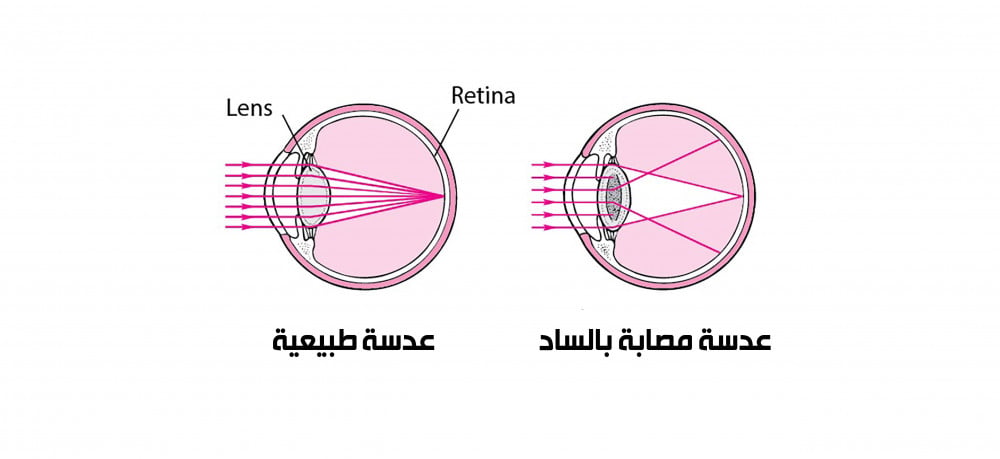 اعتام عدسة العين